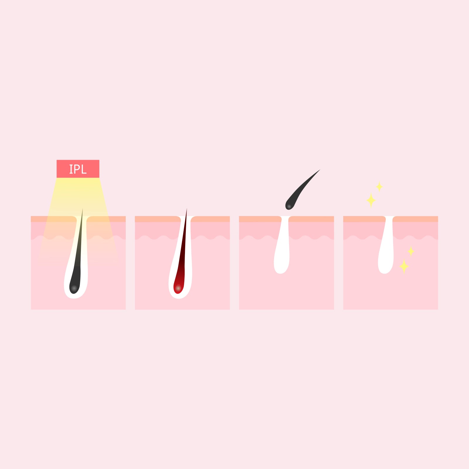 Hair Removal: Silhouette Portable Laser Hair Remover Permanent Epliation System Body Face Home