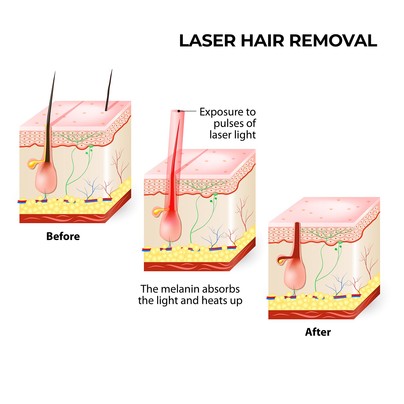 Hair Removal: Silhouette Portable Laser Hair Remover Permanent Epliation System Body Face Home