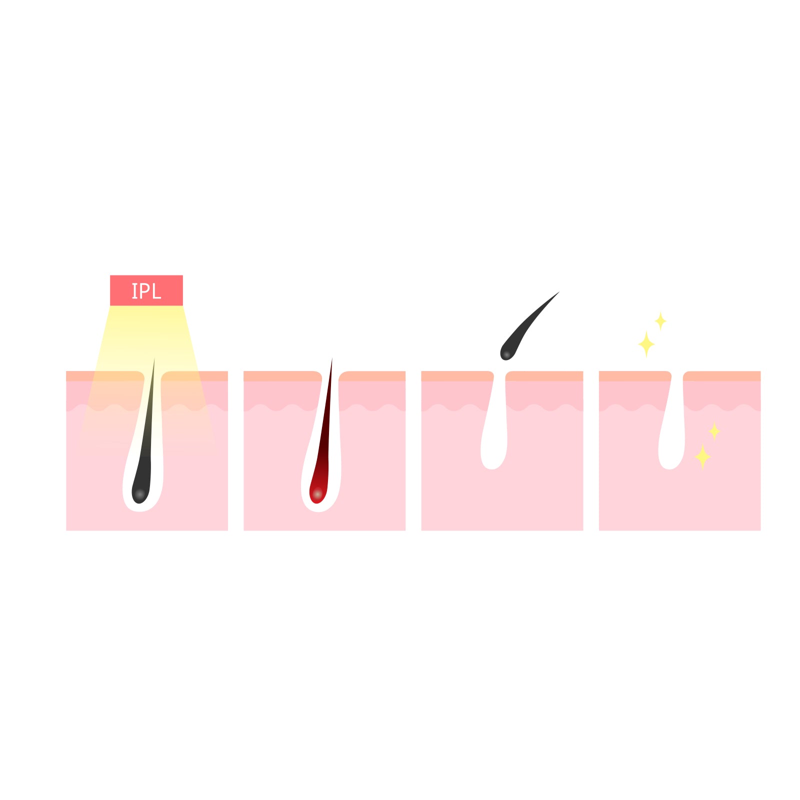 Hair Removal: Silhouette Portable Laser Hair Remover Permanent Epliation System Body Face Home